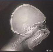 拍牙片時(shí)打了個(gè)哈欠，變成了毒液？用3D打印技術(shù)制作牙齒的好處